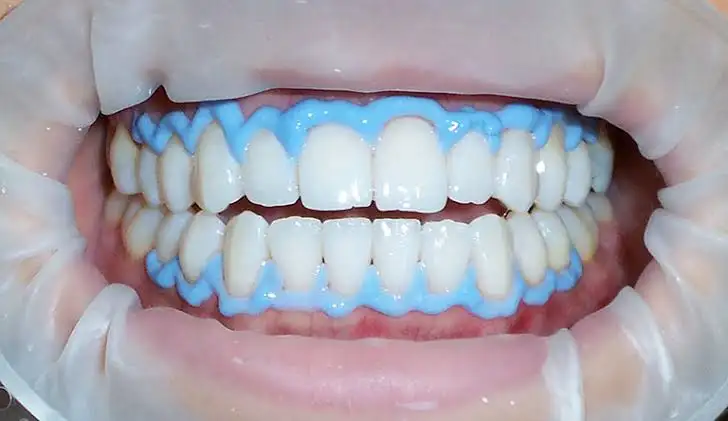 Blanqueamiento Dental